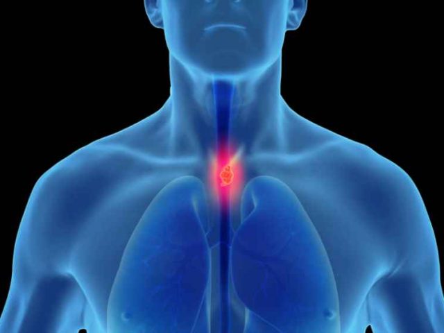 Esophageal Cancer Risk 3-to-4 Times Greater for Men Than Women