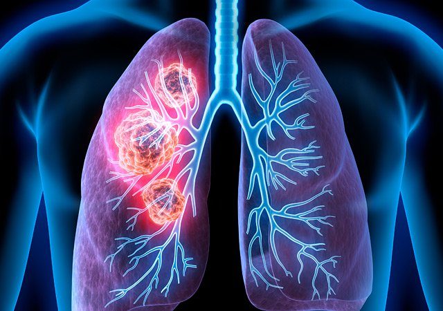 What to Know About Lung Cancer, Early Detection and Reducing the Risks