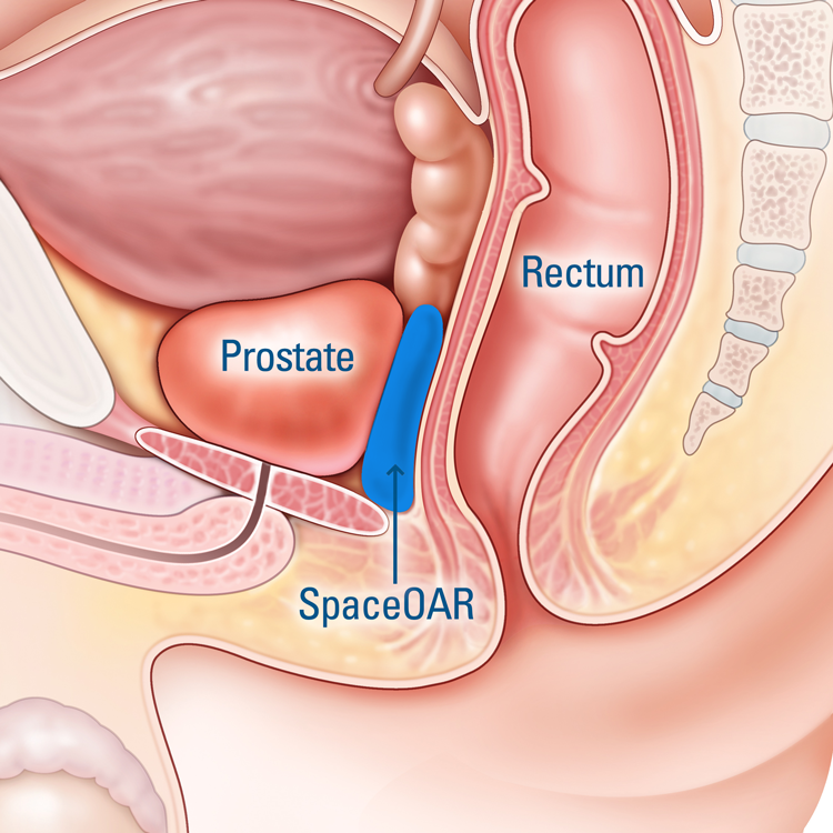 prostate cancer treatment
