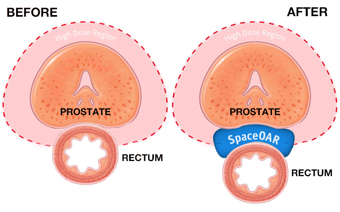 prostate cancer treatment 