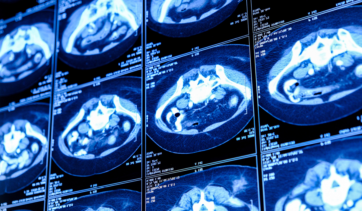 THE IMPORTANCE OF LUNG CANCER SCREENING